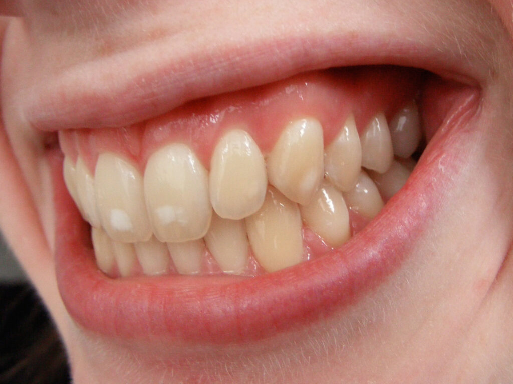 White or Chalky Spots on the Teeth