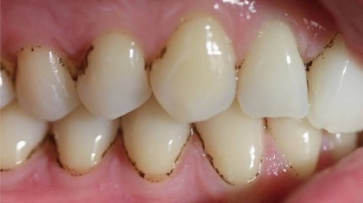 Brown or Black Spots